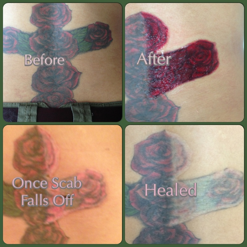 Non Laser Tattoo Removal | San Antonio, Texas - Mad Makeup Permanent ...