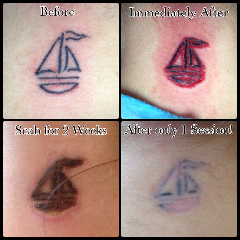 Tattoo removal process pictures 4 sessions Into the process  r TattooRemoval