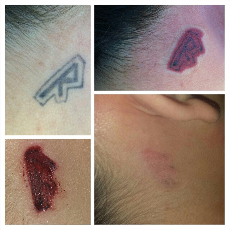 Vanish Tattoo Removal  Home  Facebook