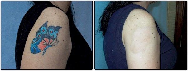 Noninvasive  nonlaser tattoo removal technique  Linda Paradis Group